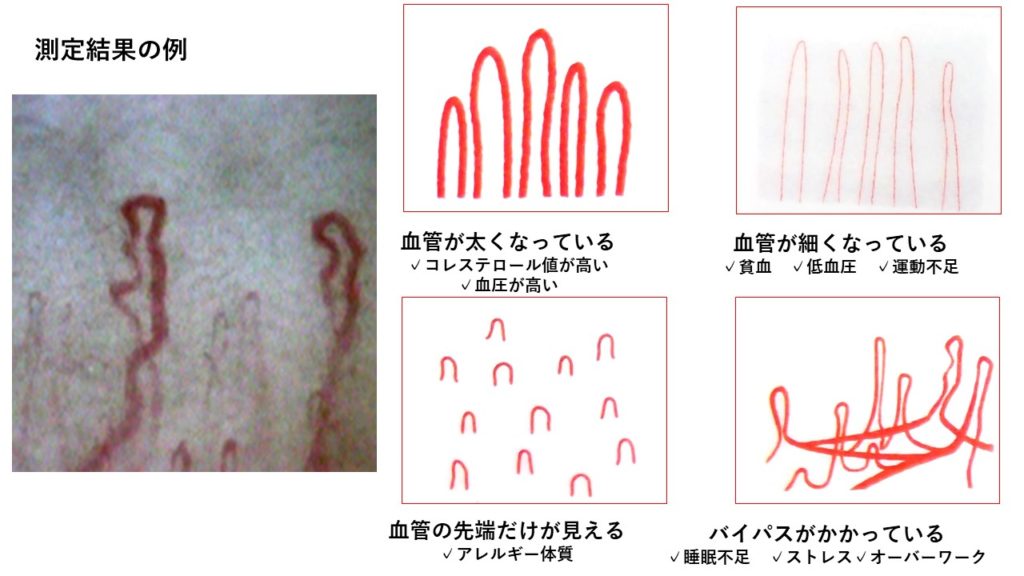 毛細血管の形状の種類（事例）
